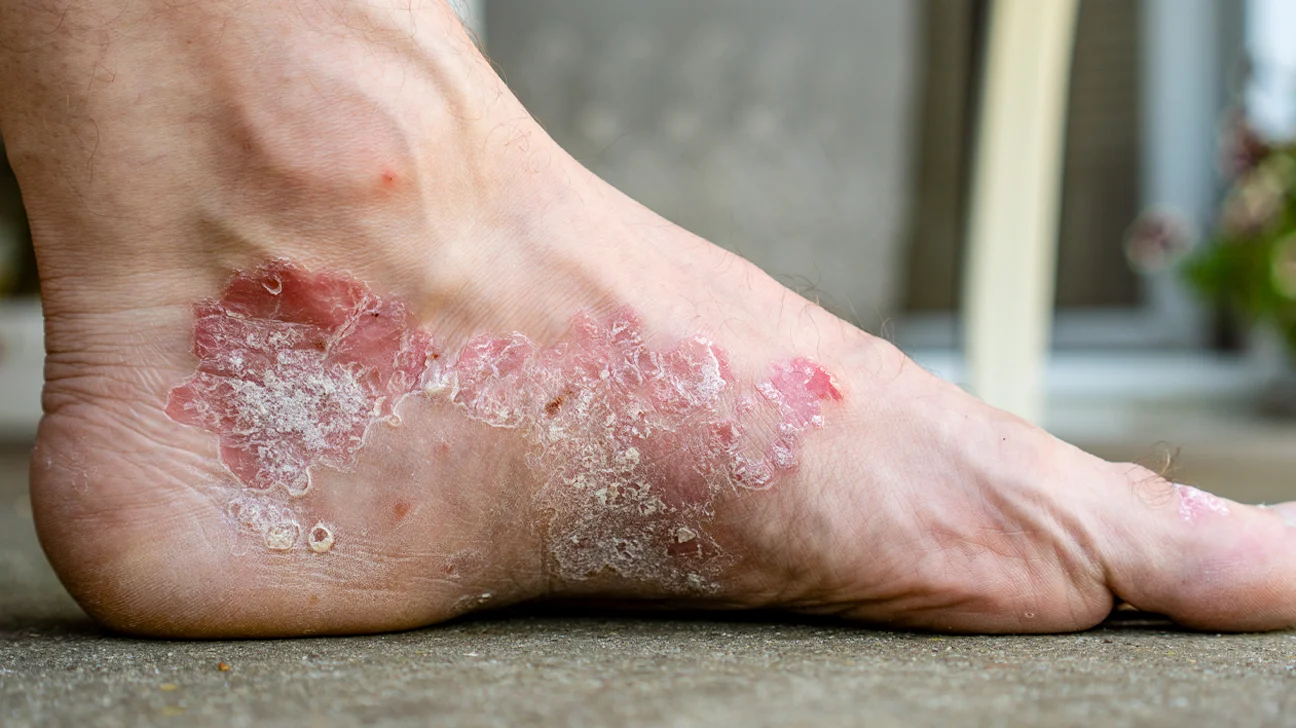 Medical Conditions Associated With Cracked Heels