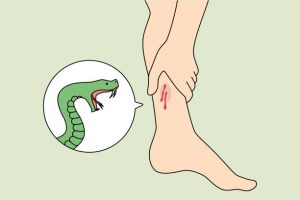 Snake bites on the foot - Mr Steve Edwards