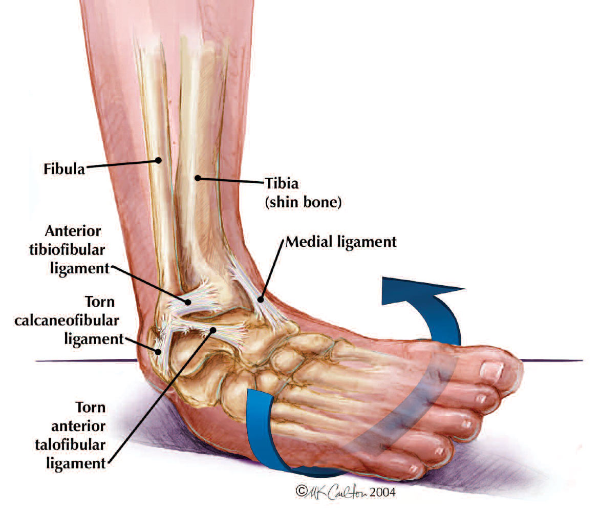 Ankle sprain classification - Mr Steve Edwards